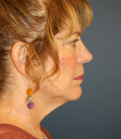 Feel Beautiful - Neck Lift Surgery San Diego - Before Photo